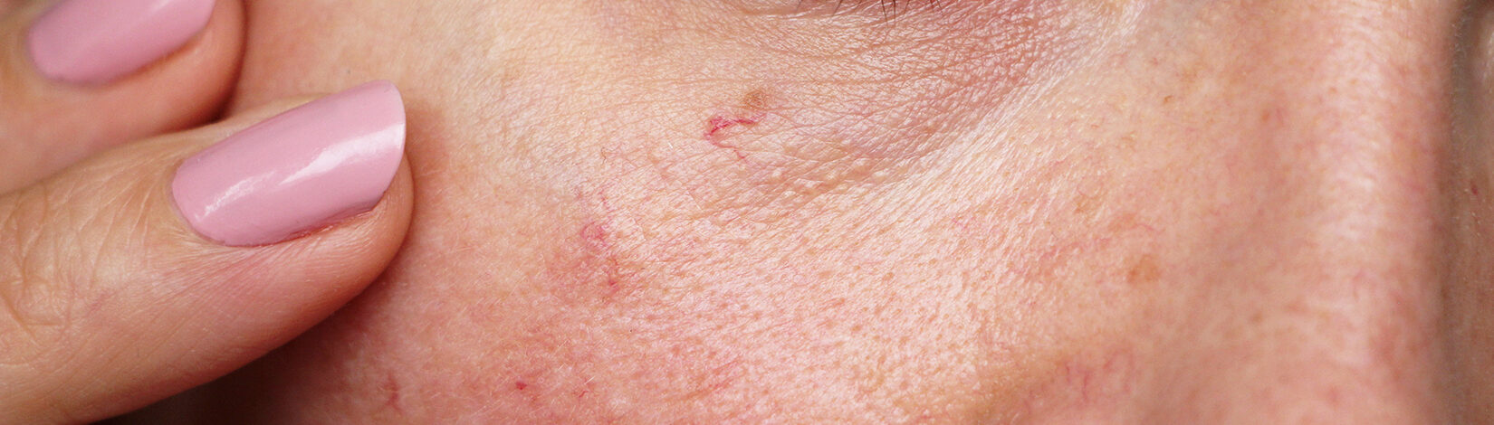 https://www.jesmondbeauty.co.uk/wp-content/uploads/2024/03/veins-header.jpg