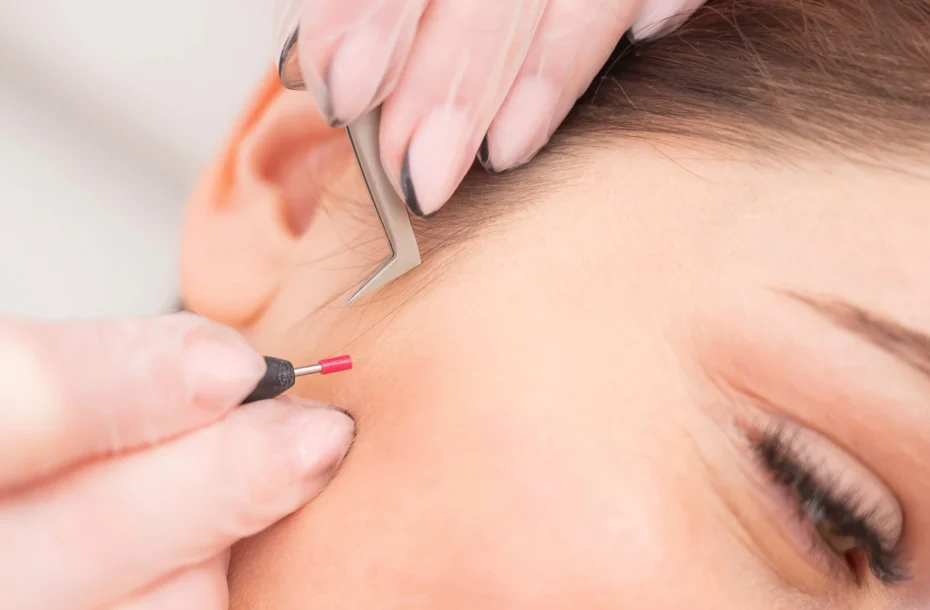 Is electrolysis permanent? Everything you need to know about electrolysis hair removal
