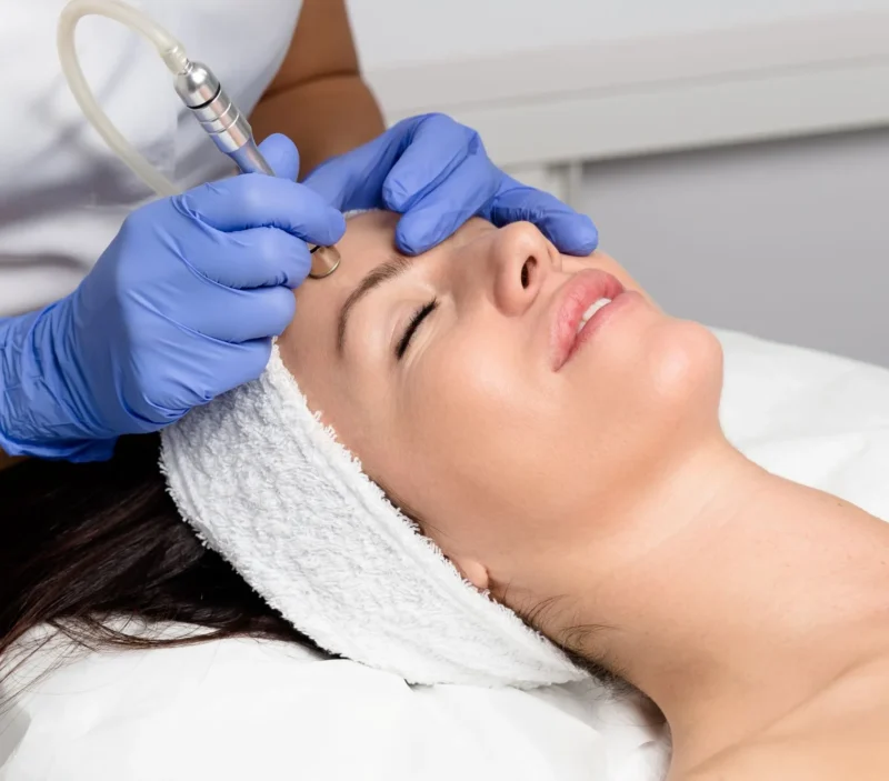A closeup of a client receiving a professional microdermabrasion facial treatment on their forehead.