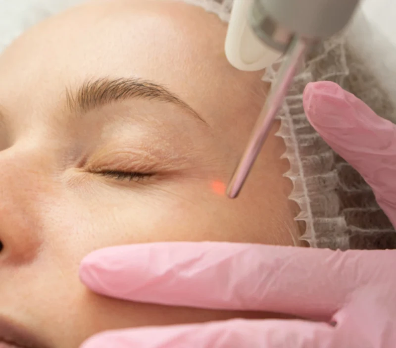 A close up of a cleint receiving a hydrafacial treatment with the laser focused on their cheekbone.